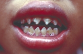 Filed teeth