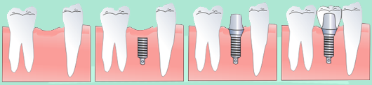 Implants - process